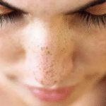 Lekelerden kurtulmanın yolu: Aydın’da Güneş Lekeleriyle Mücadele Etmenin Etkili Yolları